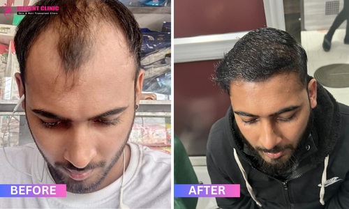 best hair transplant result in patna